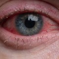 Can Optometrists Prescribe Eye Drops?
