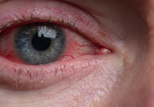 Can Optometrists Prescribe Eye Drops?